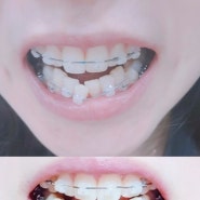 치아교정 마무리 단계(1년 9개월) 자가결찰(데이몬)장치 장단점