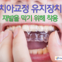 치아교정 유지장치 재발을 막기 위해 착용
