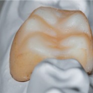 [치아의 기본 형태] 자연치 형태의 관찰로 시작하는 수복치료 _ 3
