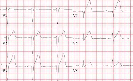 Anterior MI Example – Isolated J Point Elevation : 네이버 블로그
