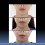 안면비대칭 환자의 턱끝재건수술 과 연부조직의 관계 : 성형부작용 카페 또는 단톡방에 대한 단상