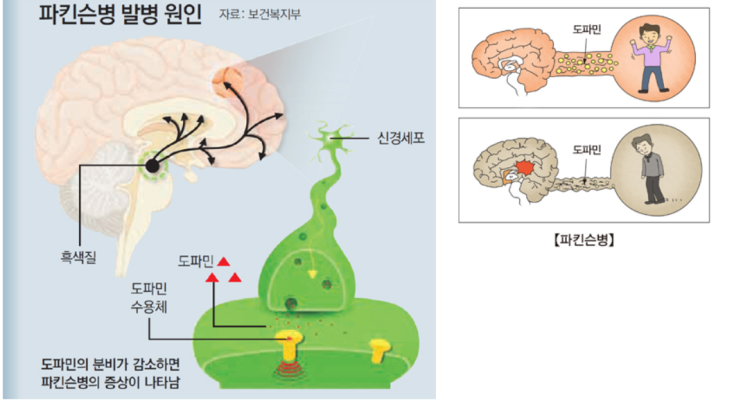 떨림이 지속된다면? 파킨슨 알아보자 : 네이버 블로그