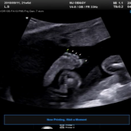 임신 21주 : 정밀검사