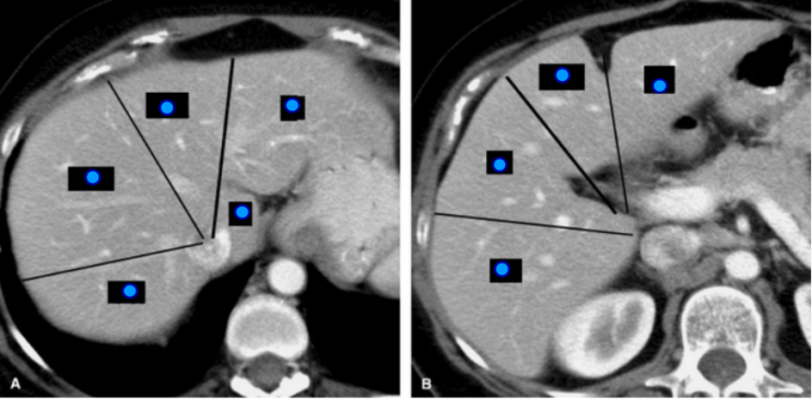 간 엽/분절 해부학(liver lobe/segment anatomy): CT 판독 Couinaud : 네이버 블로그