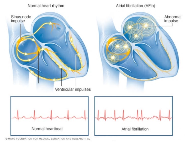 심방세동 치료 가이드라인 : 네이버 블로그