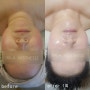 [신대방역 피부관리] 하라네이처/하라에스테틱 안면홍조 관리
