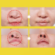구순구개열(언청이) 코,입술,인중 원스톱 수술