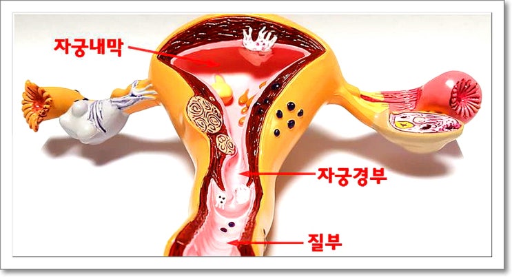 생리 후 질 분비물의 특징과 자궁 질환일 경우 상태는 : 네이버 블로그