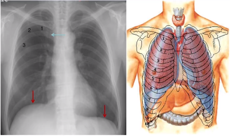 정상 흉부 X선 사진 (X-ray)  해부학 구조, 기본 판독 방법 : 네이버 블로그