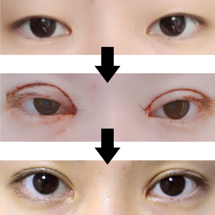 쌍수 절개 아웃라인 & 눈매교정 1년 후기 (붓기과정 & 재수술) : 네이버 블로그