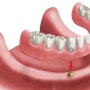 임플란트 오버덴쳐(overdenture)란 무엇인가요