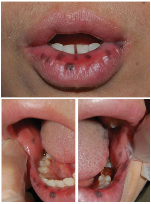 입술 검은 반점, 잇몸 검은 반점 치료 - 포이츠-제거스 증후군 vs 로지에-훈지커 증후군 : 네이버 블로그