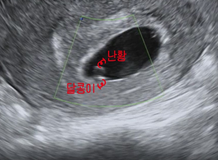 임신 초기 5주 6주 증상 정리하기! : 네이버 블로그