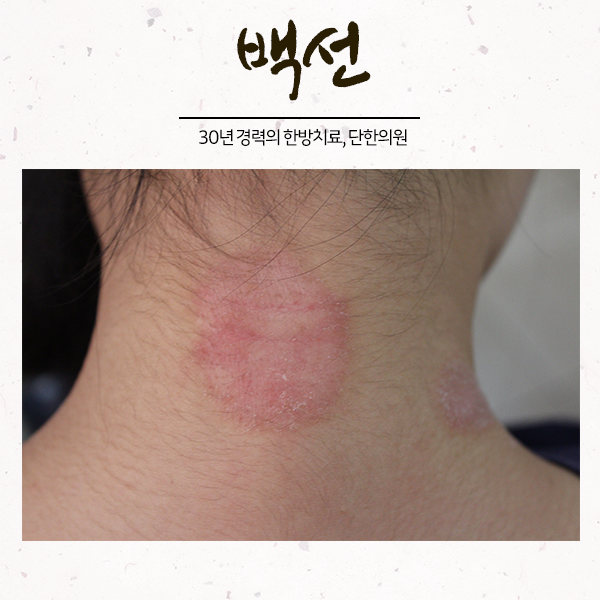 만성피부질환 백선 증상, 원인과 치료방법은? : 네이버 블로그