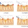 치주치료방법 소개 #치근면활택#치주소파#치주판막수술