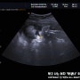 임신 31주 정기검진 , 임신8개월 나타나는 증상 ) 심해진 부종 , 가진통 , 유즙분비 , 하늘보고있는아기