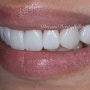 앞니 라미네이트,치아성형의 새로운 패러다임을 만들어가는 치과의사 이야기