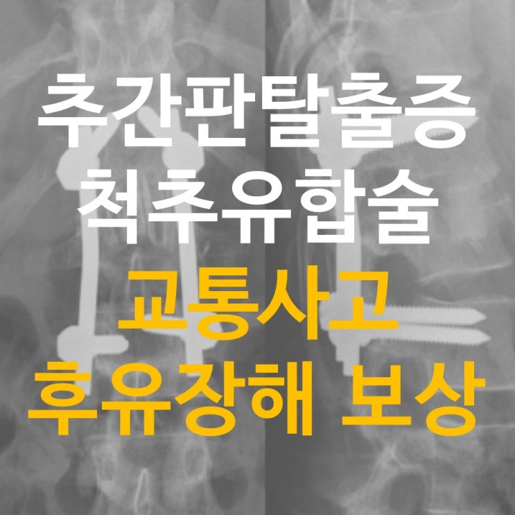 [추간판탈출증 척추유합술 교통사고 후유장해 보상] 디스크, 추간판탈출, 자동차사고 보상 제대로 받기 : 네이버 블로그