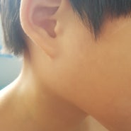 아이 오른쪽 귀밑부터 턱관절 부음(이하선염, 침샘 염증)