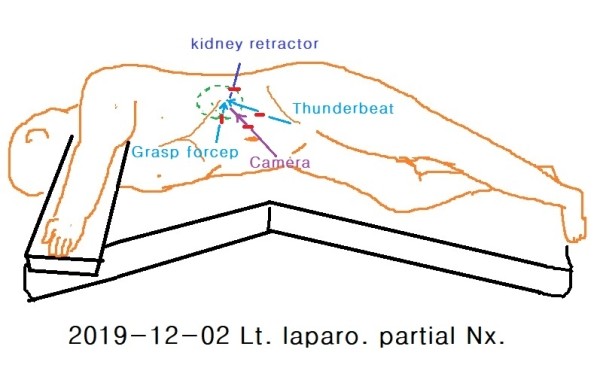 2019-12-02 좌측 복강경하 부분신절제술 (left laparoscopic partial nephrectomy) & 포경 ...