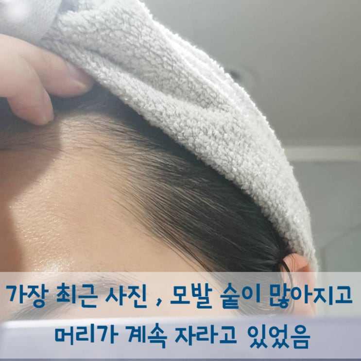 m자탈모 치료 6개월차 후기 + 두피상태 : 네이버 블로그