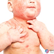 어린이 아토피 피부염 치료와 올바른 관리 방법은?