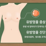 유방멍울 증상이 보인다면?