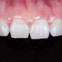 앞니 라미네이트, Handmade로 아름다운 자연치를 표현하는 치아성형 과정