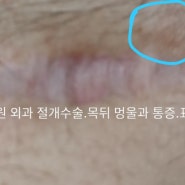 2019년 12월 31일 목뒤멍울 안산 ㅎ병원 외과 수술(표피낭종) 상태와 병원의 오처방, 은인인 대명약국