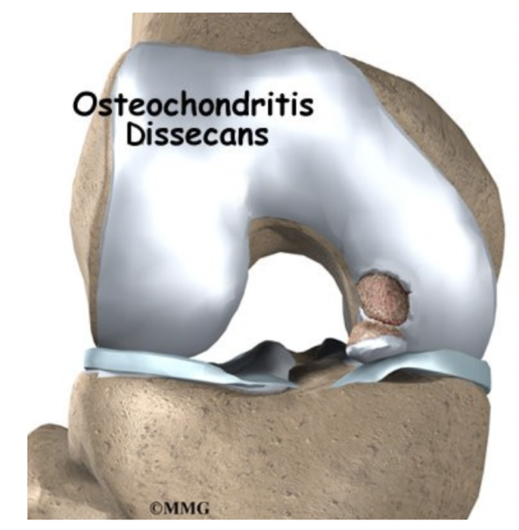 Knee Osteochondritis dissecans(무릎 박리성 골연골염) : 네이버 블로그