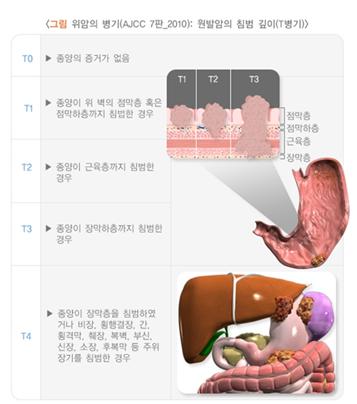 위암(Stomach Cancer) 간호 : 네이버 블로그