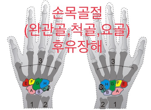 손목골절(요골,척골,완관절 골절)-후유장해 : 네이버 블로그