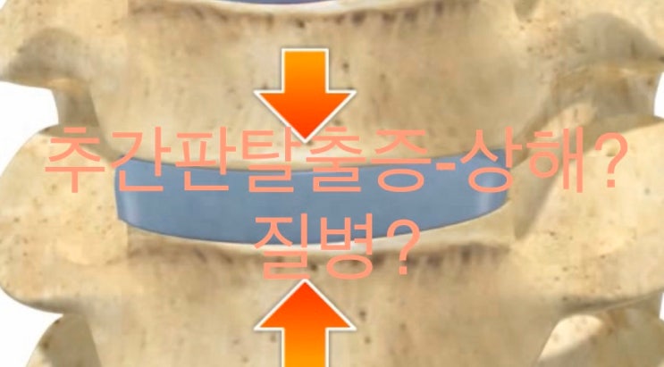 추간판탈출증(디스크탈출)-상해인가요? 질병인가요? : 네이버 블로그
