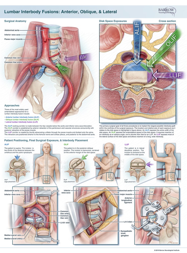 OLIF(Oblique Lateral Interbody Fusion) : 네이버 블로그