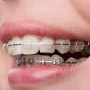치아교정 치료기간 얼마나 걸리나요?
