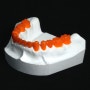 치과보철 브릿지 제작에 사용되는 3D프린팅