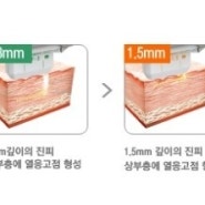 주름 피고 처진 살 올리는 하이푸리프팅 원리를 알아보자