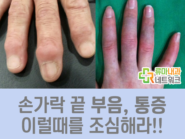 손가락 끝 부음 통증 이럴때 조심해야!! : 네이버 블로그
