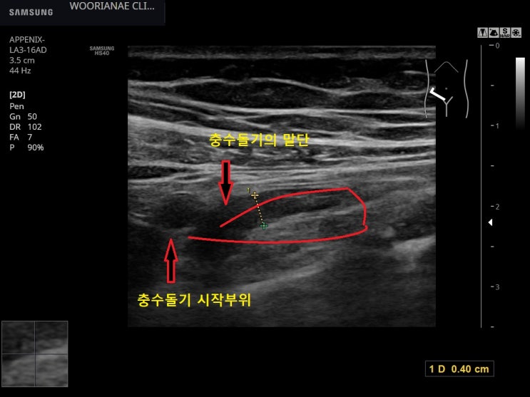 급성기간을 벗어나는? 상복부 경련성 통증, 우하복부 압통, 정상충수돌기, 장간막림프절염에 준해 치료, 증상 추적 - 동대문구 ...