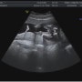 성별 확인?!, 임신중기 출혈, 태동 (16주1일~18주0일)