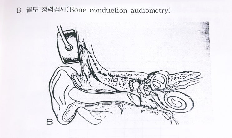 골도 청력검사 Bone conduction audiometry : 네이버 블로그