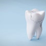 < 치아 균열 vs 치아 파절 > I. 치아에 금이 있어요.