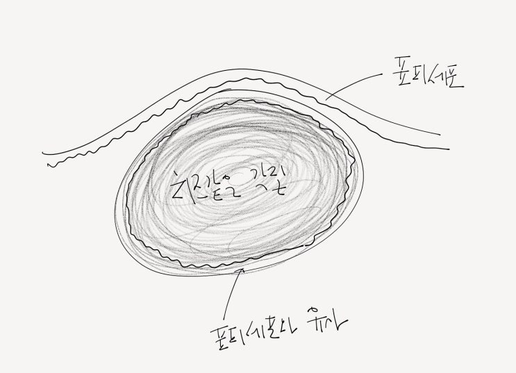 표피낭종 원인과 수술적 제거 : 네이버 블로그