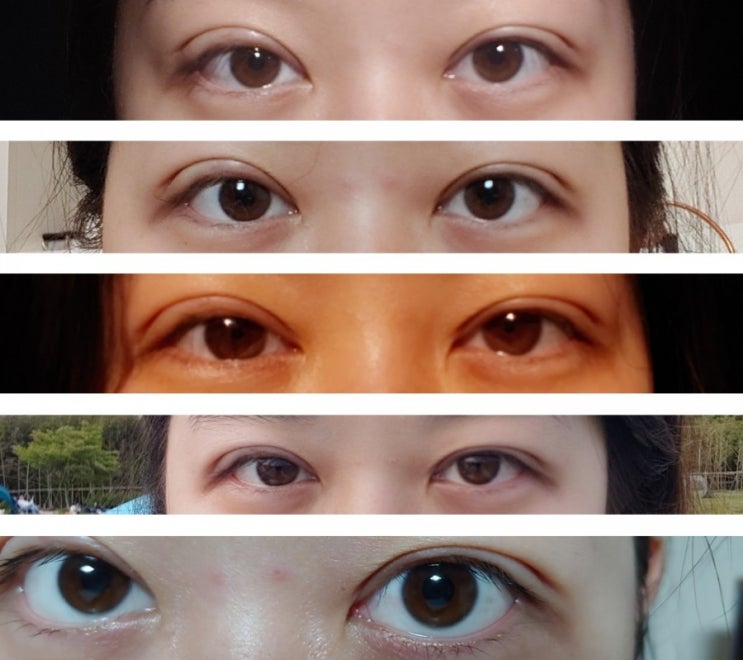 [쌍수후기] 쌍꺼풀 절개 재수술 후기 #2 (11일 - 20일, 2주/3주차) 광고아님 : 네이버 블로그