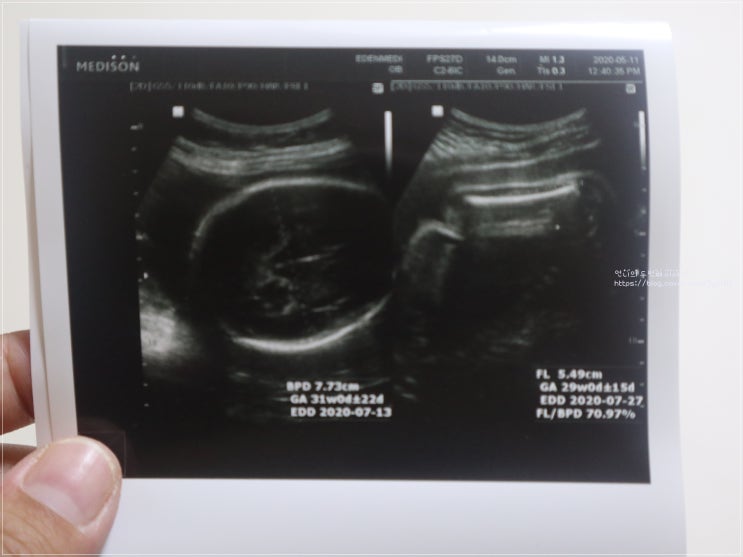 임신32주 태아몸무게 작은 아기 / 태동검사와 배뭉침 : 네이버 블로그