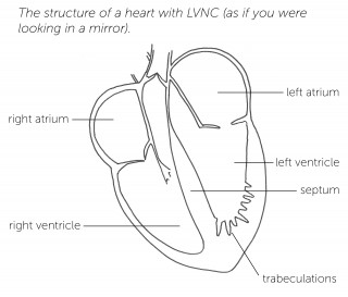Left ventricular non-compaction (LVNC) : 네이버 블로그