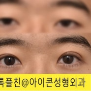 부드러운 인상으로 변하는 남자눈수술후기