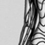 팔부위의 거대(대형) 밀크커피반점의 저출력 타켓포커싱치료 - 블라스코 라인과의 연관성