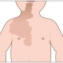 맥쿤 알브라이트 증후군 - 체간부위의 거대 밀크커피반점