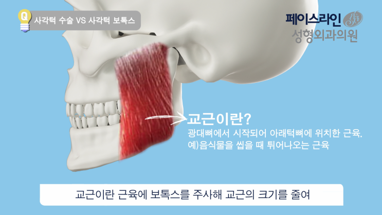 사각턱개선방법, 안면윤곽(사각턱수술)vs보톡스 : 네이버 블로그